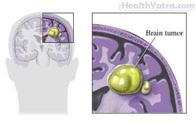 glioblastoma multiforme causes delirium brain treatment gbm optune