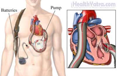 Heart Assist System Implantation