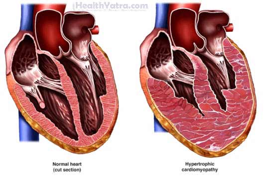Hypertrophic Cardiomyopathy Adult