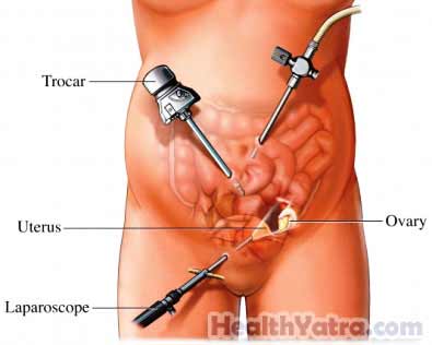 Hysterectomy Laparoscopic Surgery