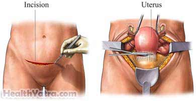 Hysterectomy Open Surgery