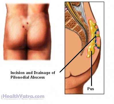 Incision and Drainage of a Skin Abscess