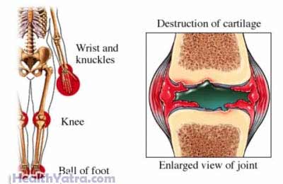 Juvenile Rheumatoid Arthritis