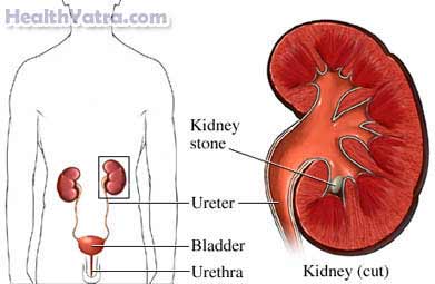 Kidney Stones Adult