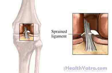 Knee Sprain1