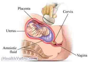 Macrosomia1