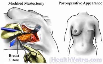 Mastectomy 1