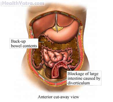 Mechanical Bowel Obstruction