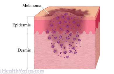 Melanoma Removal