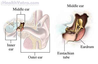 मध्य कान का संक्रमण