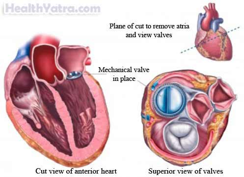 Mitral Valve Replacement