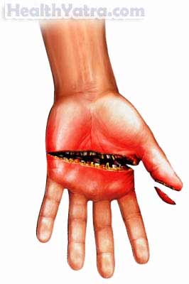 Mutilating Hand Injuries