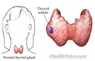 Needle Biopsy Thyroid