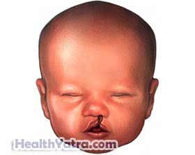 Oral Facial Clefts
