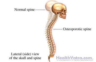 Osteoporosis1