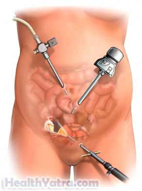 Ovarian Cyst Removal Laparoscopic Surgery