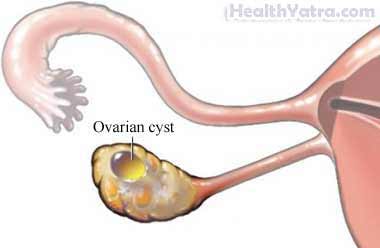 Ovarian Cyst Removal Open Surgery 1