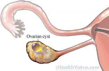 Ovarian Cyst Removal Open Surgery