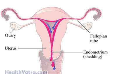 Painful Menstrual Periods