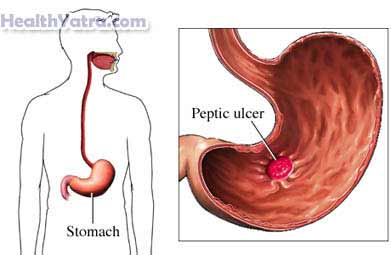Peptic Ulcer 1