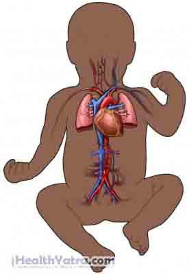 Persistent Pulmonary Hypertension of the Newborn