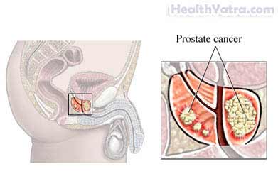 Prostate Biopsy 2