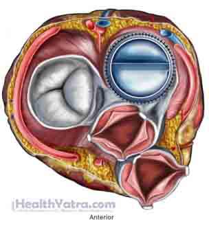 Prosthetic Heart Valve Thrombosis