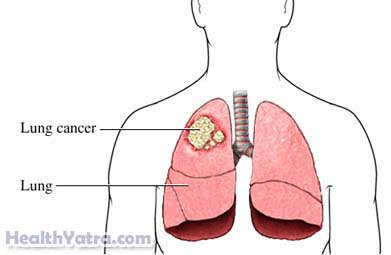 Pulmonary Lobectomy 1