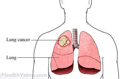 Pulmonary Lobectomy