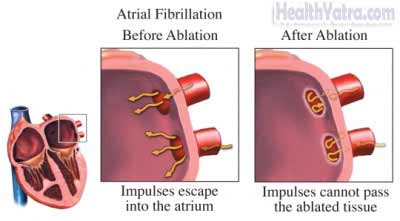 Radiofrequency Ablation2