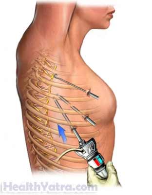 Robot Assisted Thoracic Procedures