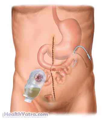 Small Bowel Resection1