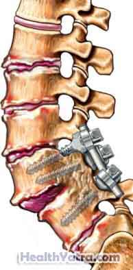 Spinal Fusion1 1