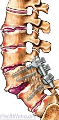 Spinal Fusion2