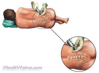 Spinal and Epidural Anesthesia