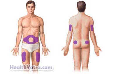 Subcutaneous Injection1
