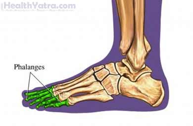Toe Fracture