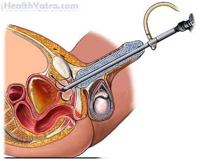 Transurethral Resection of the Prostate 1