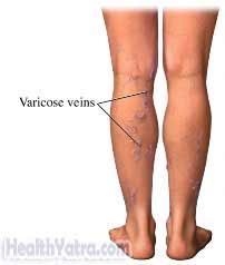 Treatment of Varicose Veins of the Leg