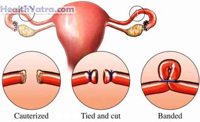 Tubal Ligation Laparoscopic Surgery 1