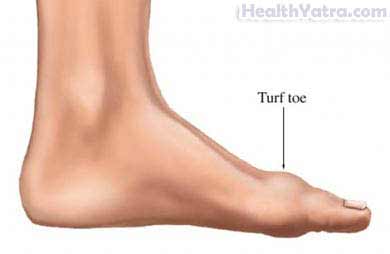 Turf Toe