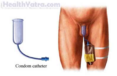 Urinary Incontinence Male