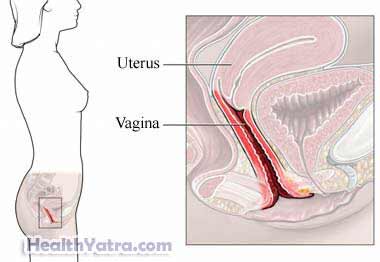 योनि में खमीर का संक्रमण