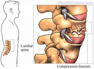 Vertebral Compression Fracture