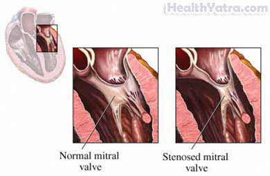 Mitral Stenosis Adult