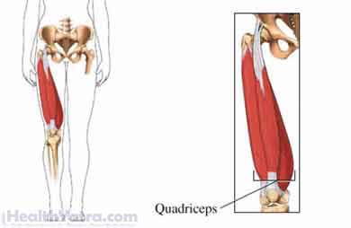 Quadriceps Strain