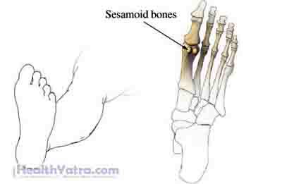 Sesamoid Fracture
