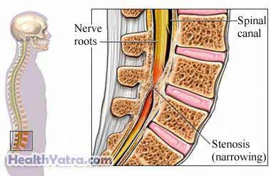Spinal Stenosis 1