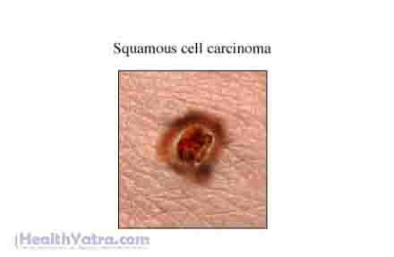 त्वचा कोशिकाओं का कार्सिनोमा