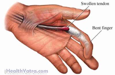 إصبع الزناد والأسباب والأعراض وعلاج التكلفة الجراحية في الهند